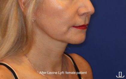 Facelift / Neck Lift Before & After Patient #16747