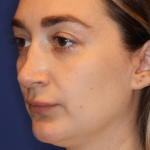 JL Facial Balancing Before & After Patient #16748