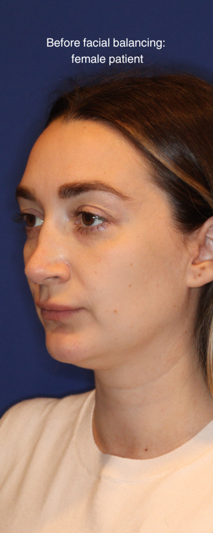 JL Facial Balancing Before & After Patient #16748