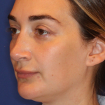 JL Facial Balancing Before & After Patient #16748