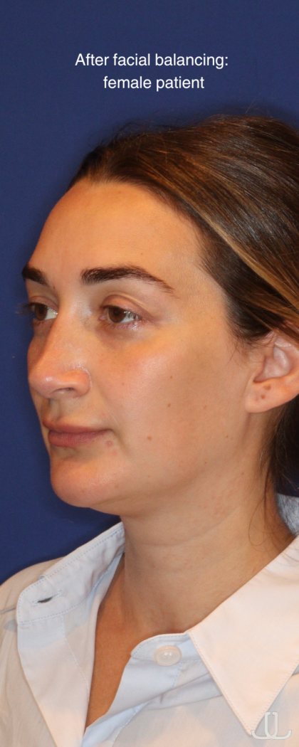 JL Facial Balancing Before & After Patient #16748