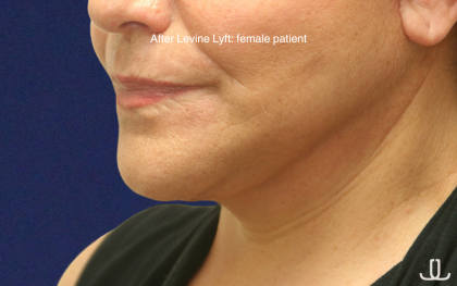 Facelift / Neck Lift Before & After Patient #16745