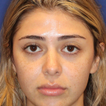 JL Facial Balancing Before & After Patient #16749