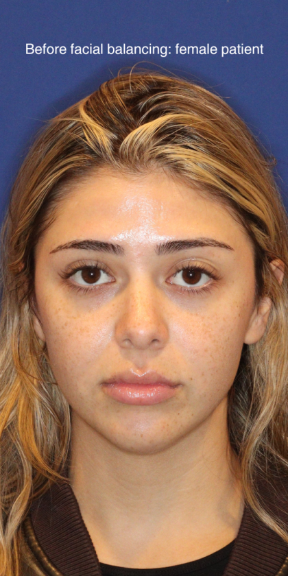 JL Facial Balancing Before & After Patient #16749