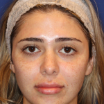 JL Facial Balancing Before & After Patient #16749