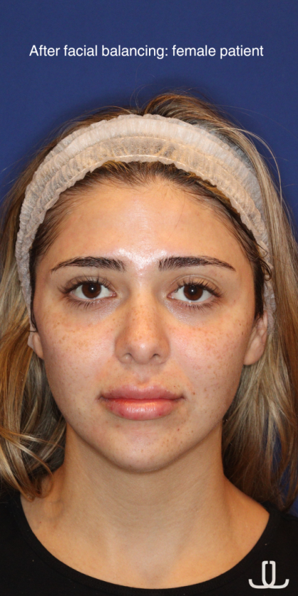 JL Facial Balancing Before & After Patient #16749