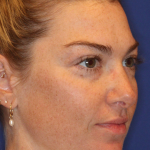 JL Facial Balancing Before & After Patient #16750