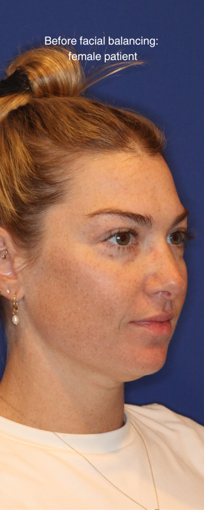 JL Facial Balancing Before & After Patient #16750