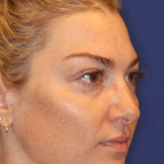 JL Facial Balancing Before & After Patient #16750