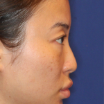 Non-Surgical Nose Job Before & After Patient #16752