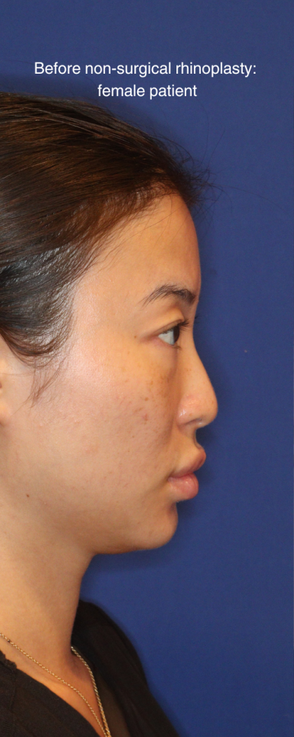 Non-Surgical Nose Job Before & After Patient #16752