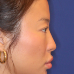 Non-Surgical Nose Job Before & After Patient #16752