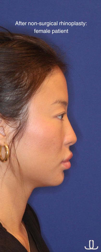 Non-Surgical Nose Job Before & After Patient #16752