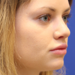 Rhinoplasty Before & After Patient #16814