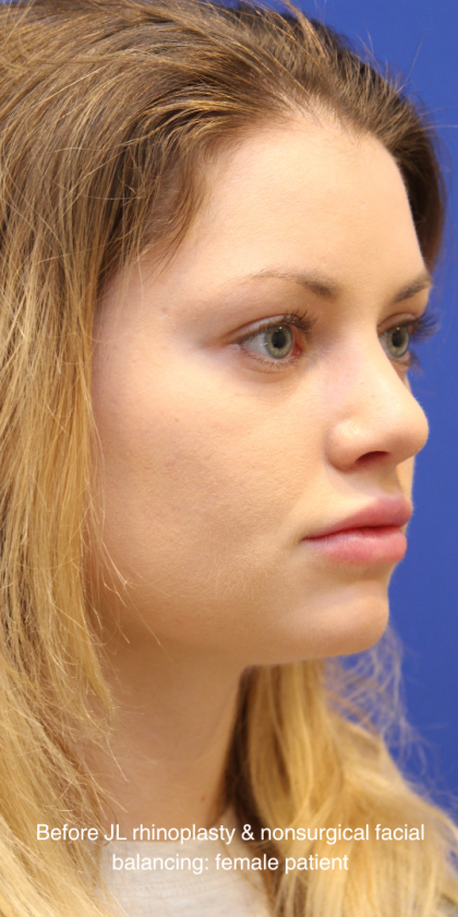 Rhinoplasty Before & After Patient #16814
