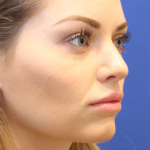Rhinoplasty Before & After Patient #16814
