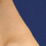 Rhinoplasty Before & After Patient #16754