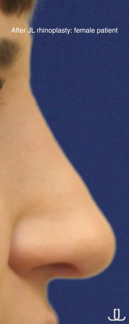 Rhinoplasty Before & After Patient #16754