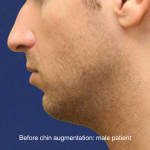 Chin Augmentation Before & After Patient #16741