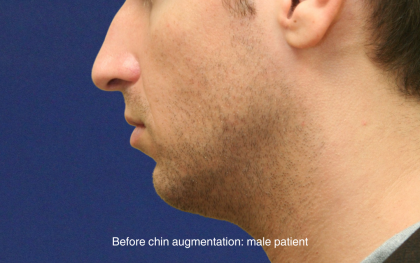 Chin Augmentation Before & After Patient #16741