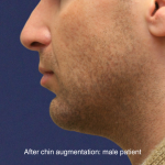 Chin Augmentation Before & After Patient #16741