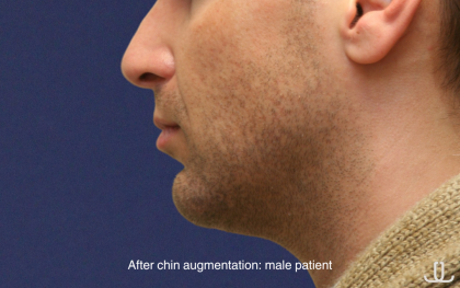 Chin Augmentation Before & After Patient #16741