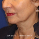 Facelift / Neck Lift Before & After Patient #16747