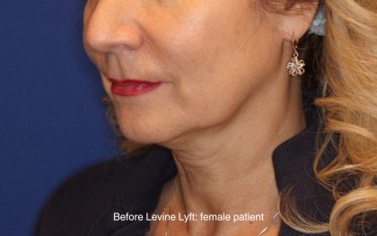 Facelift / Neck Lift Before & After Patient #16747