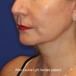 Facelift / Neck Lift Before & After Patient #16747