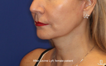Facelift / Neck Lift Before & After Patient #16747