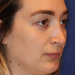 JL Facial Balancing Before & After Patient #16748
