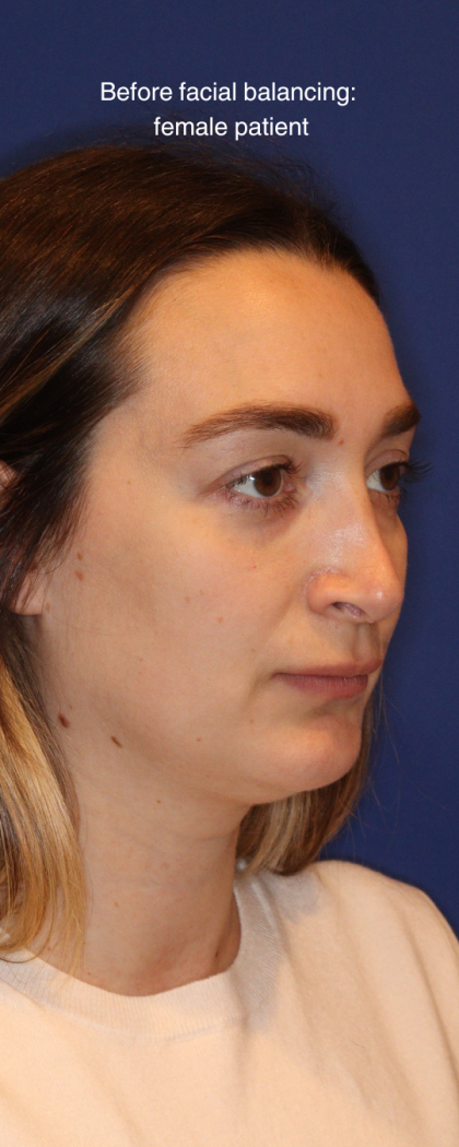 JL Facial Balancing Before & After Patient #16748