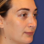 JL Facial Balancing Before & After Patient #16748