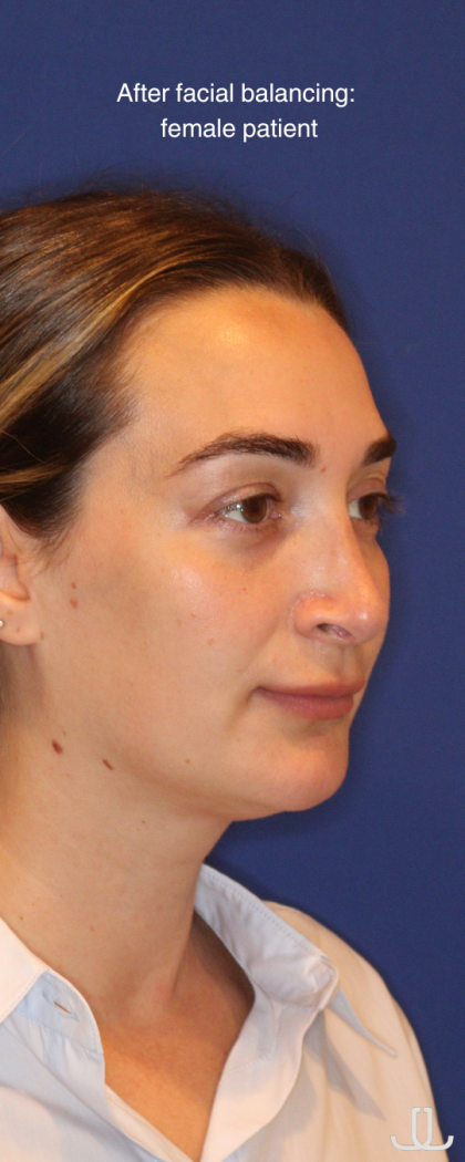 JL Facial Balancing Before & After Patient #16748
