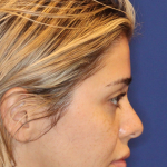 JL Facial Balancing Before & After Patient #16749