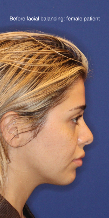 JL Facial Balancing Before & After Patient #16749