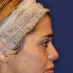 JL Facial Balancing Before & After Patient #16749