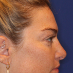 JL Facial Balancing Before & After Patient #16750
