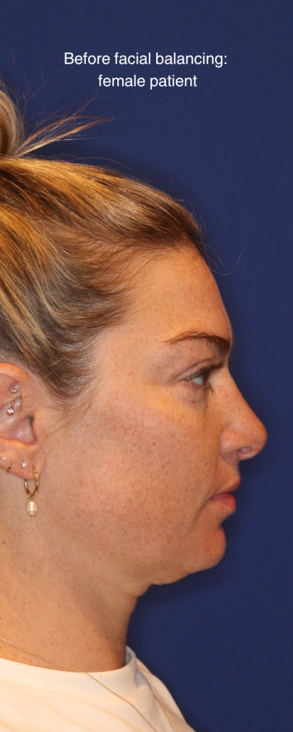 JL Facial Balancing Before & After Patient #16750
