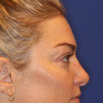 JL Facial Balancing Before & After Patient #16750