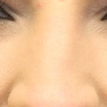 Rhinoplasty Before & After Patient #16754