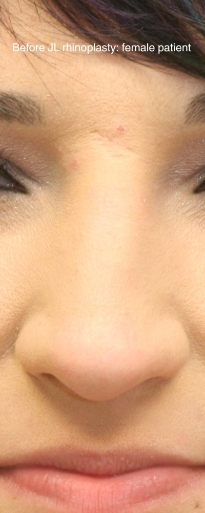 Rhinoplasty Before & After Patient #16754