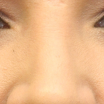 Rhinoplasty Before & After Patient #16754