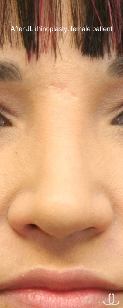 Rhinoplasty Before & After Patient #16754