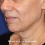 Facelift / Neck Lift Before & After Patient #16746