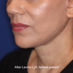 Facelift / Neck Lift Before & After Patient #16746