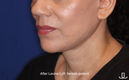 Facelift / Neck Lift Before & After Patient #16746