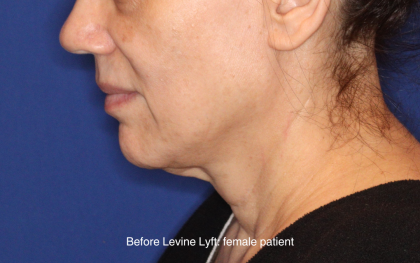 Facelift / Neck Lift Before & After Patient #16746