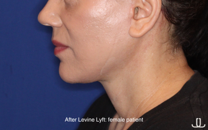 Facelift / Neck Lift Before & After Patient #16746