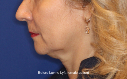 Facelift / Neck Lift Before & After Patient #16747